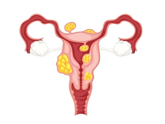 Drawing the Uterus Treatment