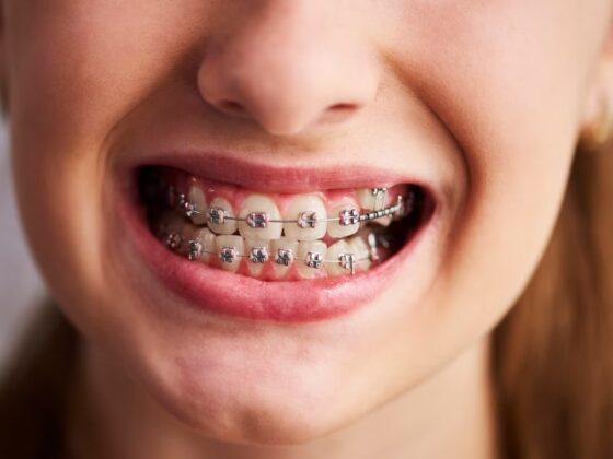 What is Orthodontic Treatment? Treatment in Turkey