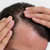 Hair Transplant in Turkey: Preferred Methods and How the Process Works