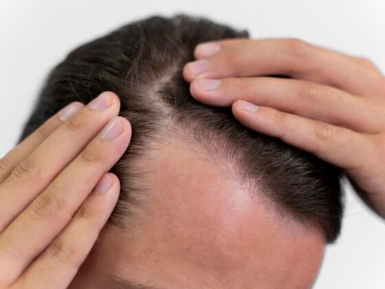 Hair Transplant in Turkey: Preferred Methods and How the Process Works