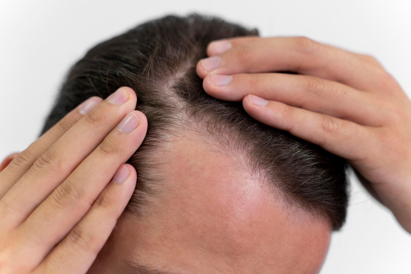 Hair Transplant in Turkey: Preferred Methods and How the Process Works