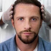 Hair Transplant in Antalya